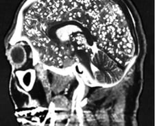 사람 조종하는 기생충…'기생충 다이어트'도 있을까?[한 장으로 보는 건강]