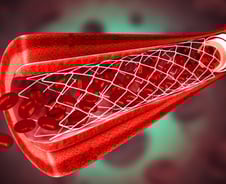 혈관 스텐트 환자, 아스피린보다 더 좋은 '이 약'…심근경색 46% ↓