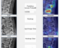 MRI 없이 진단 어려운 요추협착증, '정확도 91.4%' 엑스레이로 찾는다