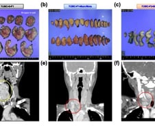 "항암제도 안 들어" 전이암 막막했는데…치료 단서 찾았다