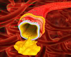 콜레스테롤 부족하면 머리 나빠진다? 천만에…"치매 위험 28% 줄어"