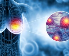 "유방암 예후 예측 정확도↑" 한국산 '온코프리', 맞춤 치료 시대 열까