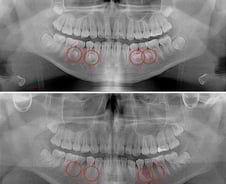 삐뚤빼뚤 치아, 숨기기만 급급했는데…뜻밖의 '구강 내 시한폭탄'