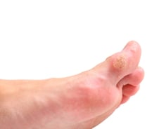 "발에 굳은살인 줄"…무심코 뜯었다가 가족까지 전염될 수도