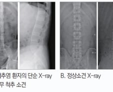 잘 잤는데 허리 통증 "디스크 아닙니다"…대나무 척추 만드는 '이 병'