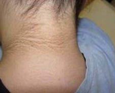 "때 낀듯 거뭇거뭇" 검게 변한 목덜미·겨드랑이…원인은 '이것'