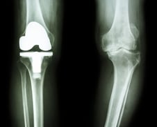 진통제 먹다 결국엔 인공관절? 달라진 무릎 관절염 치료, '이때'가 중요해