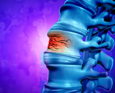 오래 쓰면 뼈 약해지는 '골다공증 치료제' 부작용 줄인 새 치료제 나오나