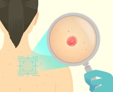 한국서 갑자기 늘어난 이 암…얼굴·몸에 생긴 '이것' 잘 살펴야