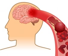 '어버버' 하더니 금세 멀쩡…"컨디션 나쁜가 봐" 넘기면 안 되는 이유