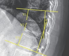 척추 압박골절, 골시멘트 시술보다 '월 1회 주사' 치료 효과 더 커