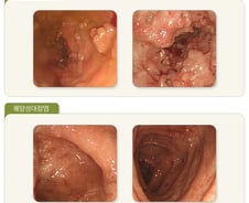 "윽, 화장실 좀…" 사라졌다 다시 생기는 '이 병' 2030 덮쳤다