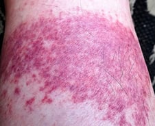 뙤약볕 골프 치고 나니 온다리에 붉은 반점…'디즈니 발진' 뭐길래