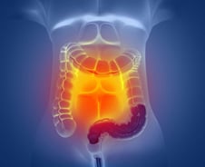 갑상선암 다음으로 흔한 암…"젊은 환자 급증" 피해야 할 음식은