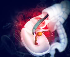 "대장에 구멍 날라" 내시경 검사 머뭇머뭇…나이보다 '이것' 더 중요