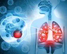 기침 없었는데 내가 결핵?…"전신에 균 퍼져" 이 증상 있다면 의심