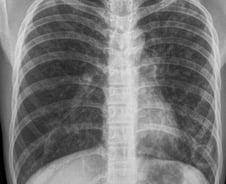 "폐암 검사 아냐?" 오히려 조기 발견 방해…환자단체 목소리 내는 이유