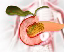 선진국서 발병 잦은데 '5년 생존율 16.5%'…잡스 앗아간 '침묵의 암살자'
