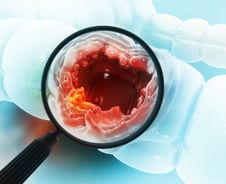 "이런 모양은 대장암 된다"…내시경 받을 때 꼭 떼내는 '용종'