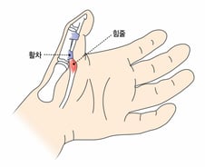 골프 시작했더니 손가락 왜 이래…펼 때마다 '딸깍' 통증 줄이려면[한 장으로 보는 건강]