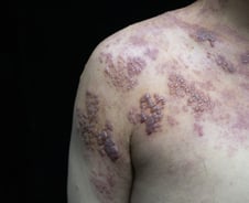 "3명 중 1명 걸린다"…찌르는 듯한 통증→띠모양 수포, 3일 넘겼다간