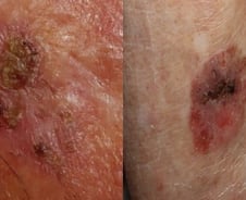 이런 '점' 암이라고? 가렵지도 아프지도 않았는데…눈으로 보는 구별법