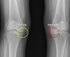 왼쪽 무릎 관절염 환자, 오른쪽도 생길까? 정답 알려주는 '모델' 나왔다