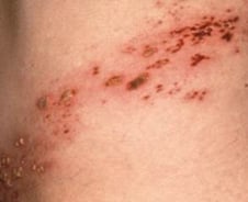 "스치기만해도 끔찍 고통" 로제도 앓은 '이 병'…2030도 노린다