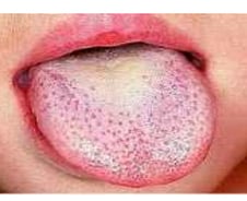"대표 증상은 딸기 혀"…요즘 유행하는 '성홍열', 여름 감기로 착각?