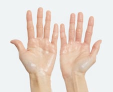 '땀 범벅' 다한증 환자, 손 수술했더니 가슴서 땀 폭발?…사실일까