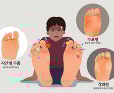 워터파크 갔다가…"어떡해, 무좀 옮았나봐"[한 장으로 보는 건강]