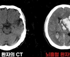 "망치로 내려찍는 듯한 두통" 고혈압 환자의 '이 증상' 골든타임도 없다