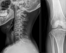 허리 아파 병원 가니 "무릎에도 병이"…10명 중 6명 동시에 앓는다