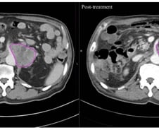 "암세포만 골라 죽였다"…방사선보다 더 효과 보인 이 치료법