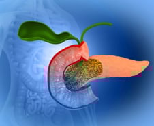 수술받더라도 치료 효과 알기 힘든 췌장암, AI로 예후 본다