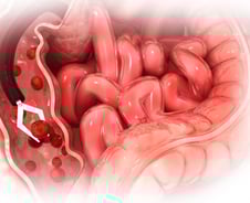 검붉은 혈변 봤다면 이미 '대장암'…내 몸이 보내는 6가지 SOS