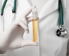 재발 많은 방광암, 분당서울대병원 소변으로 재발 예측