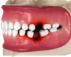 치아 빠졌다고 그냥 두지 마세요…"8개 없으면 사망위험 10%↑"