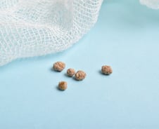 소화불량인 줄 알았는데 몸속에 '돌'…맥주 마시면 빠진다?