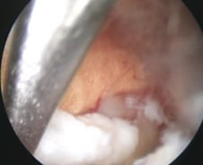 현미경보다 절반 덜 째는 '양방향 내시경' 허리디스크 치료 효과 더 좋아