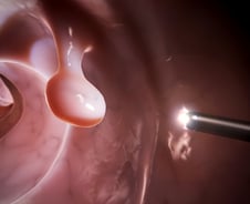 "정확도 80% 가까워" 희귀한 대장 용종까지 샅샅이 찾는 AI 나왔다