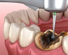 치아가 건강해야 몸도 건강하다…'이 빠진' 중년, 암 발병률 '쑥'
