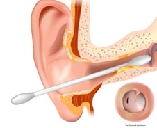 청력 손실·악성 외이도염…습관적으로 귀 파다 뇌염까지? [한 장으로 보는 건강]