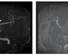 서울대병원 "소아 뇌졸중 부르는 모야모야병, 피 뽑아 조기 진단"