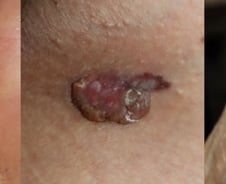 눈에 화상까지…사방에서 몰아치는 자외선, 양산으론 부족해