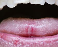 "구내염인 줄 알았는데"…혀 사진 찰칵, AI가 잡아낸 깜짝 진단