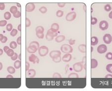 "요즘, 피부 하얘져 좋아" 70대 어르신…'이 질환' 의심 피검사 받으세요