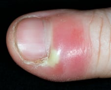 손톱 거스러미 뜯었더니 '퉁퉁'…"세균 침투 신호" 무시했다간[한 장으로 보는 건강]