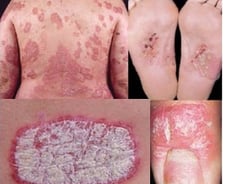 사람 몸에 '비늘'이…"서른 넘어 웬 아토피가?" 추울 때 심해지는 이 병