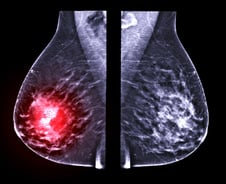 비만 아니고 너무 말라서?…40대 후반 한국 여성, 왜 '이 암' 많나 했더니